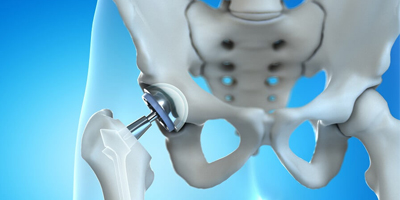 Hip Replacement treatment in Bhuj Kutch