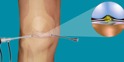 Arthroscopy Surgery in Bhuj Kutch