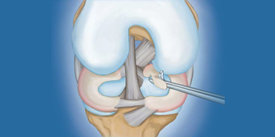 Arthroscopy Knee Joint treatment in Bhuj Kutch