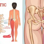 જ્યારે મણકા વચ્ચેની ગાદી કરોડરજ્જુમાંથી નીકળતાં ચેતાતંતુ પર દબાણ કરે ત્યારે તેને સાયટીકા કહે છે.