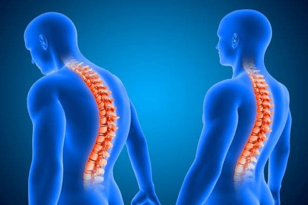 Best hospital for kyphosis (rounded neck) treatment in kutch